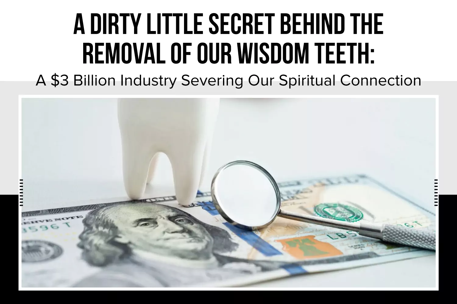 A Dirty Little Secret Behind the Removal of Our Wisdom Teeth: A $3 Billion Industry Severing Our Spiritual Connection